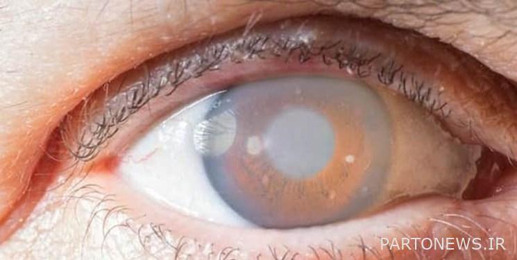 تعرف على أكثر أمراض العيون شيوعًا