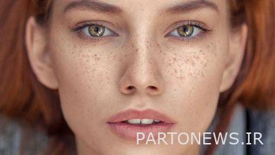 علت ایجاد لک صورت یا کک و مک چیست ؟
