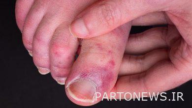 یافتههای جدید محققان در مورد پدیده "انگشت کووید"