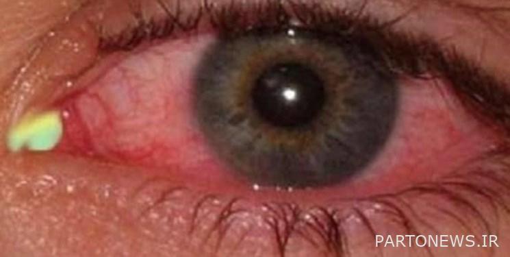 The most common "ocular" symptoms of coronary heart disease