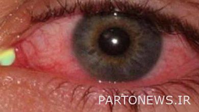 The most common "ocular" symptoms of coronary heart disease