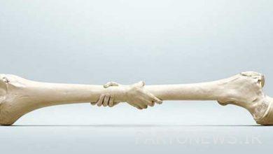 پوکی استخوان، بیماری خاموش است/ توصیه ها برای کاهش علائم پوکی استخوان