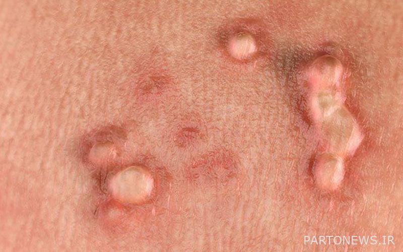 Dangerous genital warts