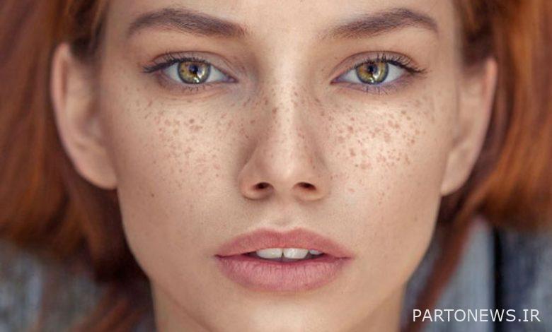 What causes facial blemishes or freckles?