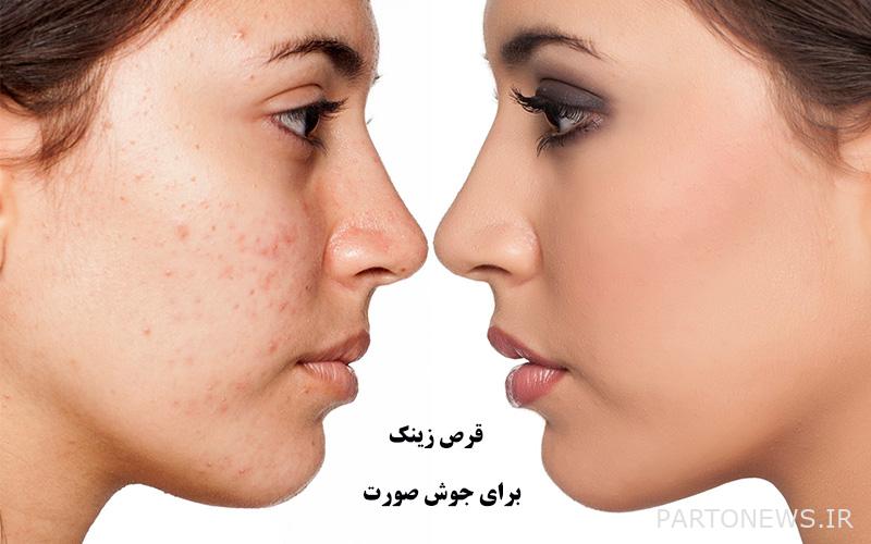 Zinc tablets for acne