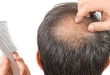 داروی درمان «ریزش موی» ایرانی مجوز مصرف گرفت