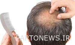 داروی درمان «ریزش موی» ایرانی مجوز مصرف گرفت