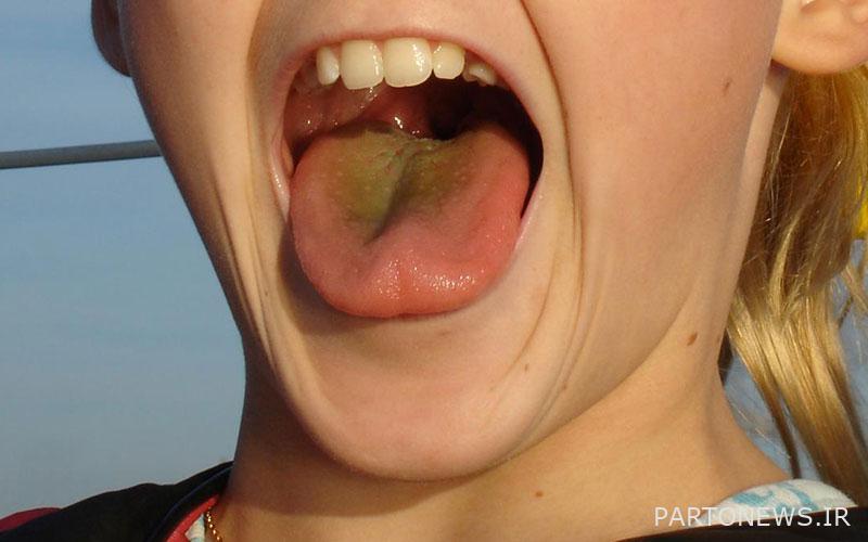 Blackening of the tongue