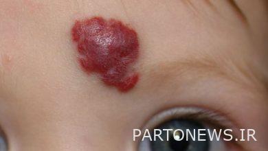 What you need to know about hemangiomas