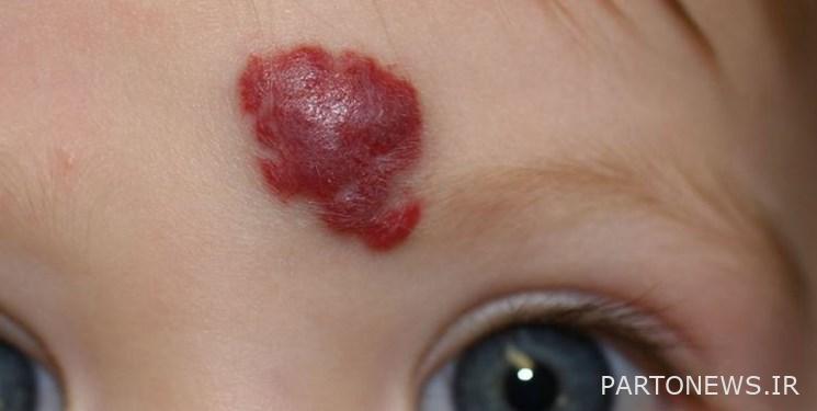What you need to know about hemangiomas