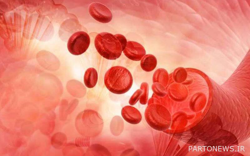 Anemia