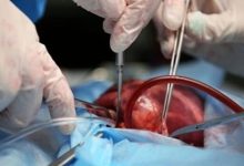 Imam Reza (AS) Hospital in Mashhad ranked third in heart transplantation in the country