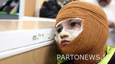 الجلد ليس لديه حرق "إصلاح" كامل