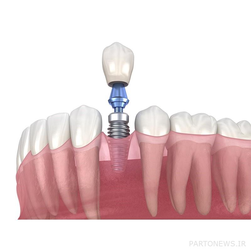 The best implant brand in 1401