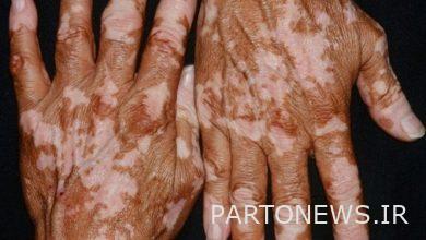 The first cell product for the treatment of "vitiligo" entered the list of drugs