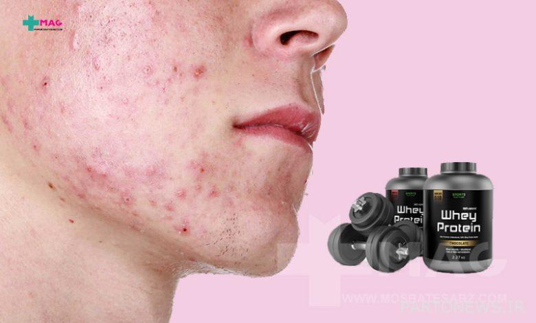 Can acne be caused by taking a bodybuilding supplement?