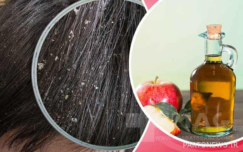 Apple cider vinegar to treat dandruff
