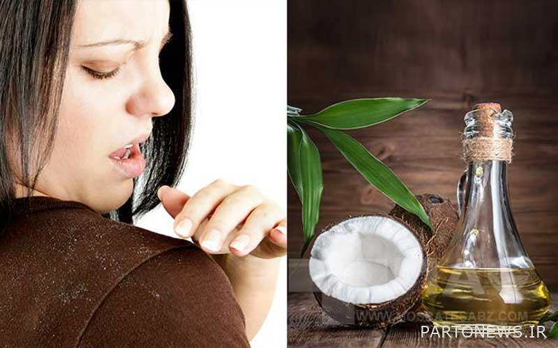 Coconut oil to treat dandruff