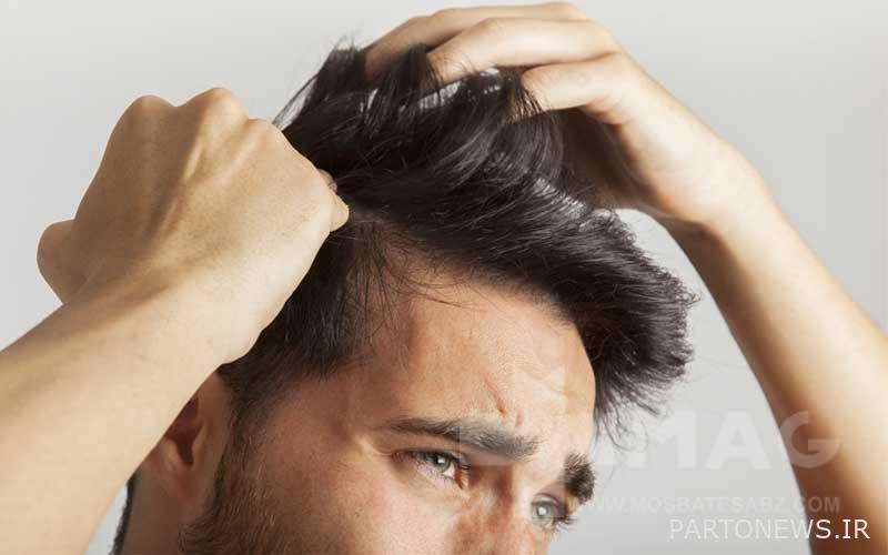 Control stress levels to deal with dandruff