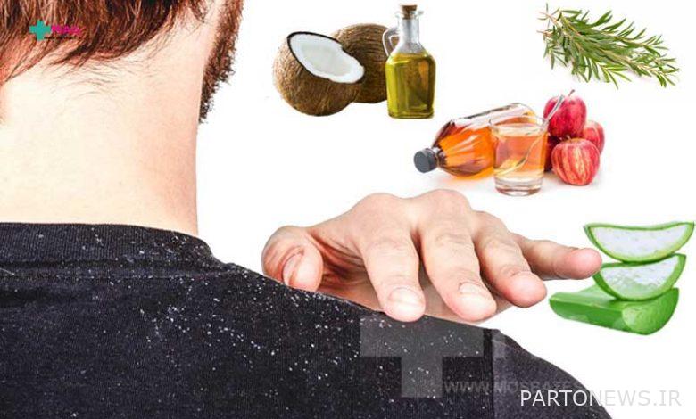 The best home remedy for dandruff