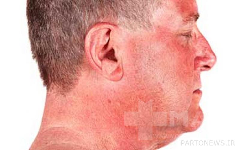 Treatment of solar eczema, how to stay safe from the sun?