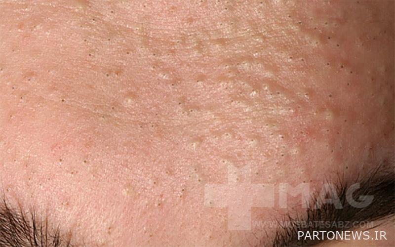 What causes acne?