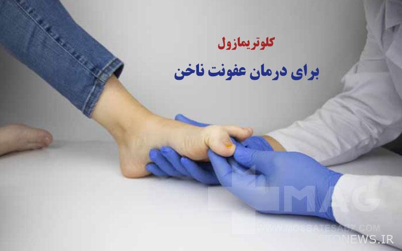 Clotrimazole to treat fungal nail infection
