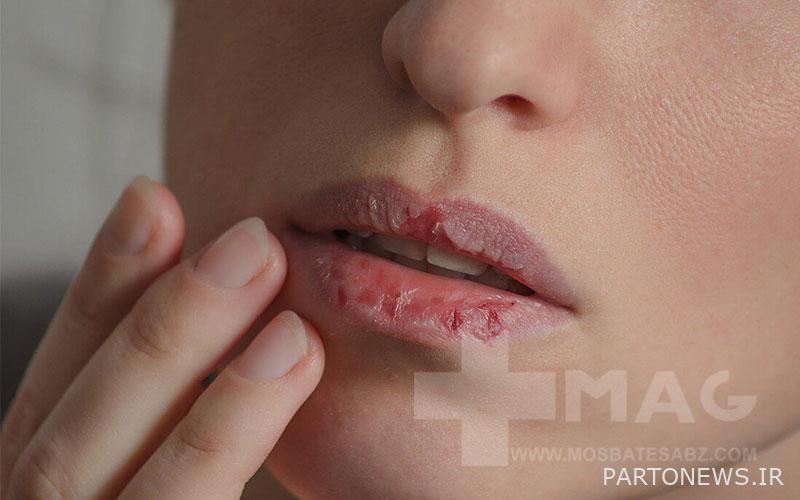 dry lips
