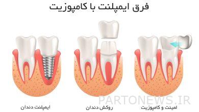 What is the difference between implant and composite? ( Difference )