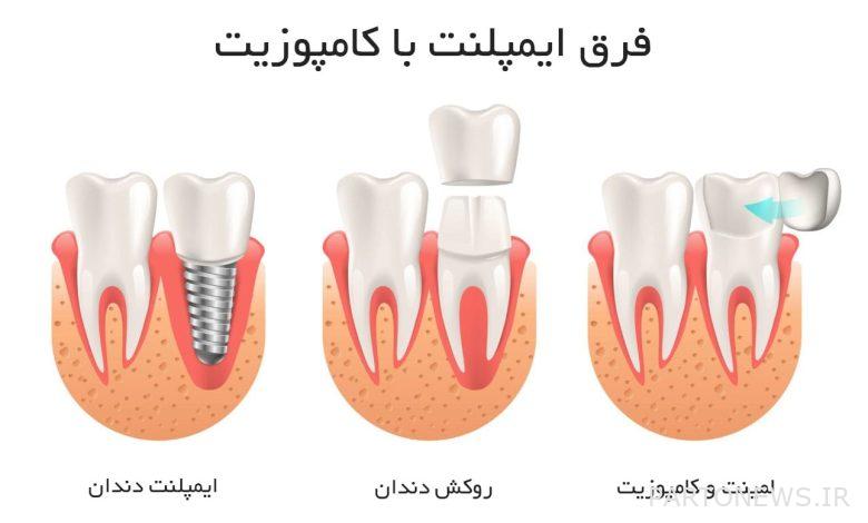 What is the difference between implant and composite? ( Difference )