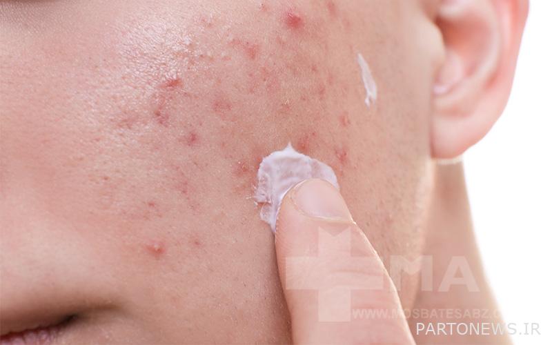 Use an anti-acne cream