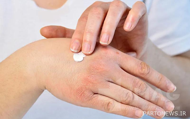 Hydrocortisone ointment