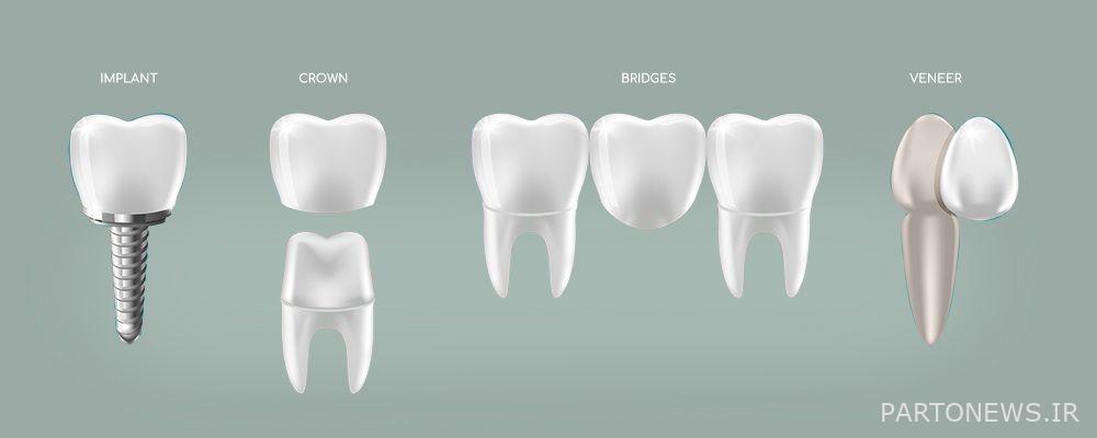 The difference between composite and implant