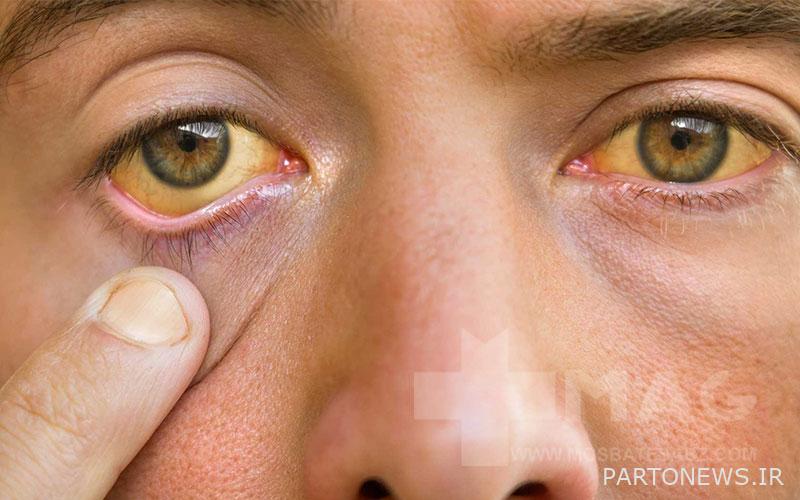 Symptoms of liver failure