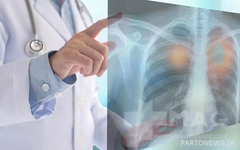 Lung diseases