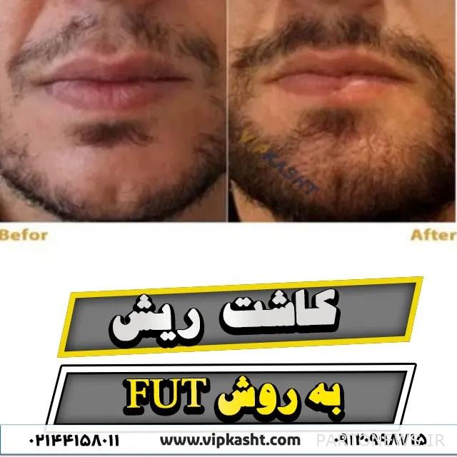 Beard planting by fut method