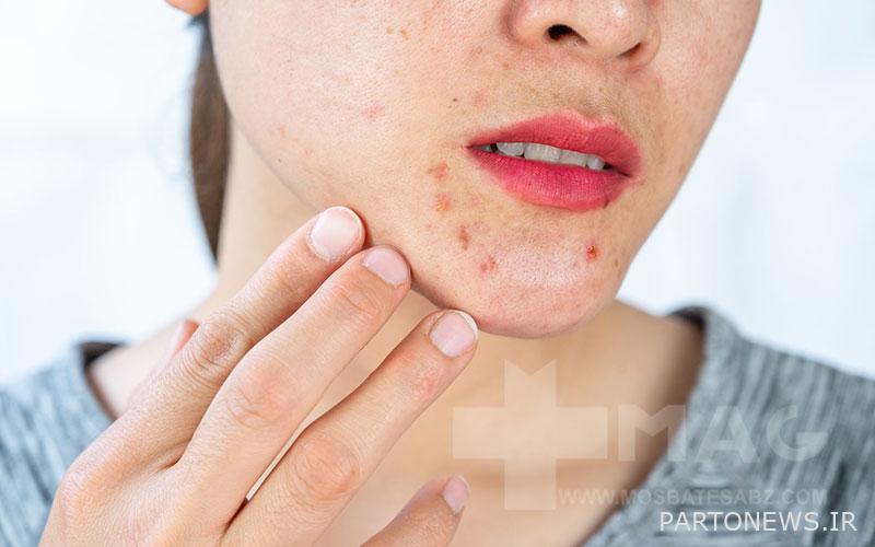Acne on the chin