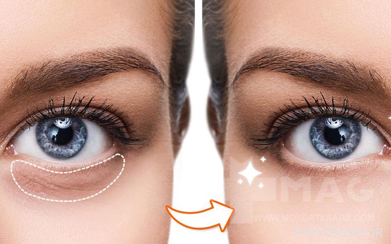 Dark circles under the eyes