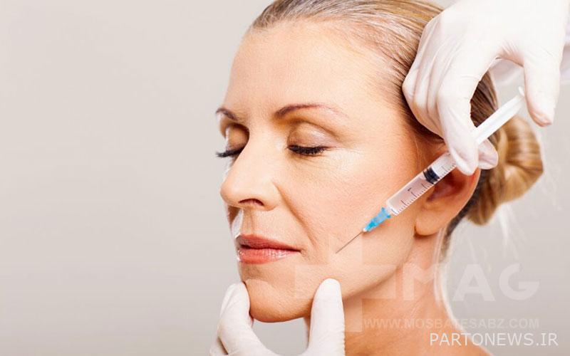 Botox to remove the laugh line around the eyes