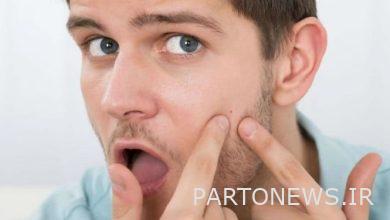 Severe acne is more common in men/ what to do with pimples?