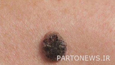 Which moles are dangerous?  |  Fars news