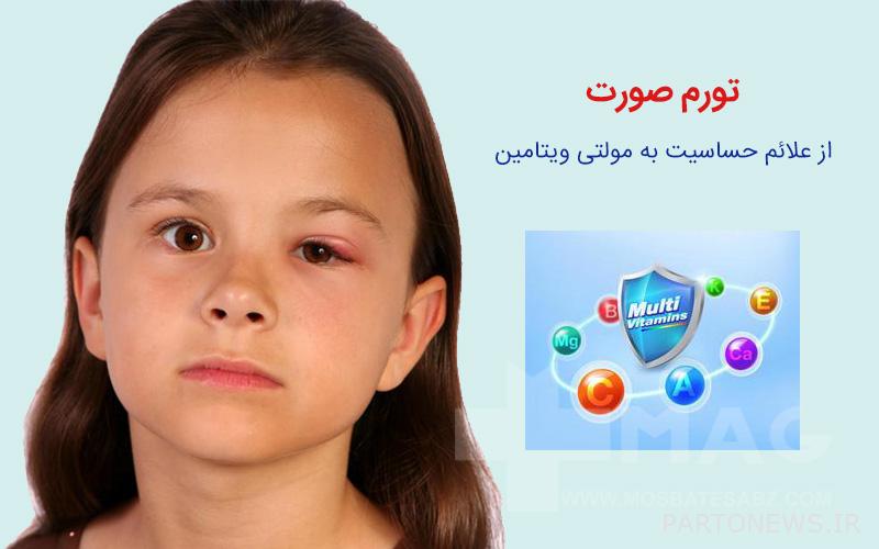 Swelling of the face is a sign of multivitamin allergy