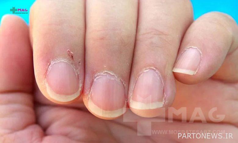 Causes and treatment of peeling around the nail | پرتو نیوز