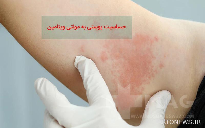 Skin sensitivity to multivitamins