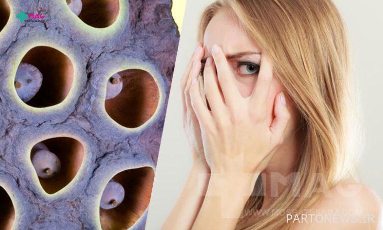 What is trypophobia? One of the strangest phobias in the world