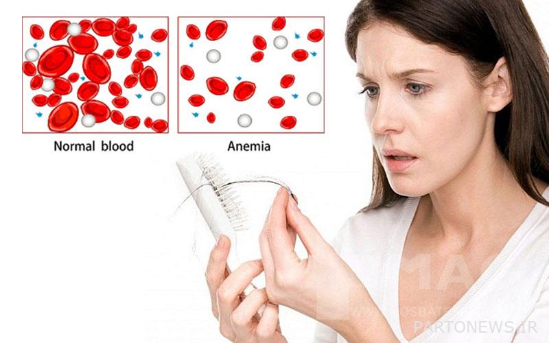 Anemia and hair loss