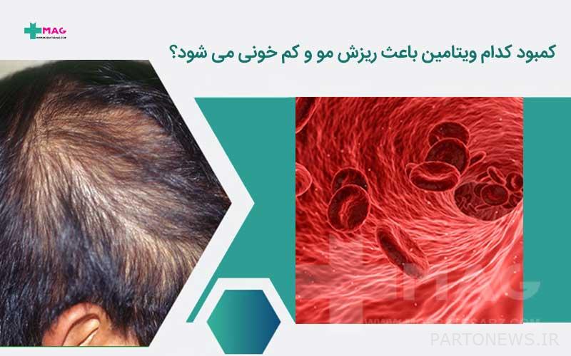 Which Vitamin Deficiency Causes Hair Loss And Anemia   Hair Fall And Anemia 