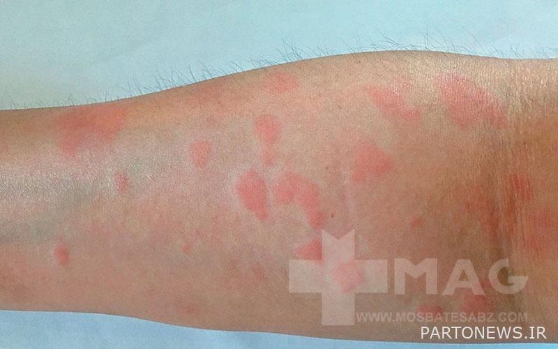 Lupus symptoms in men