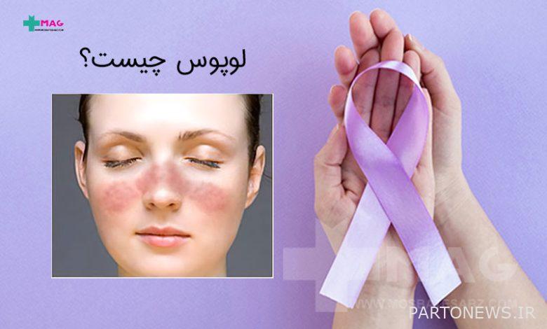 What is lupus disease? Symptoms and treatment methods