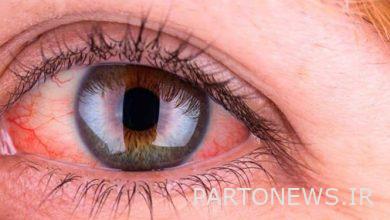 How to remove the foreign object from the eye?